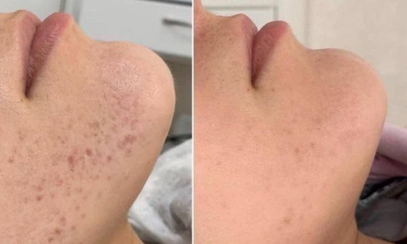 همه چیز درباره کرم لایه بردار ۱۴۰۴: AHA، BHA و نکات طلایی